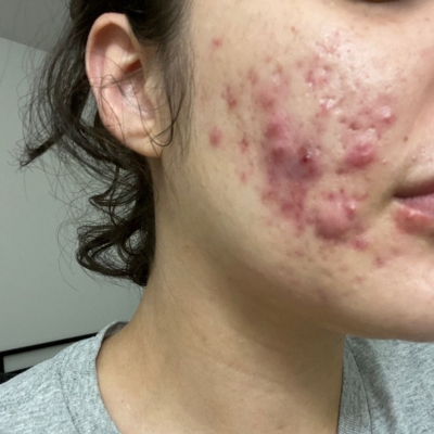 Acné